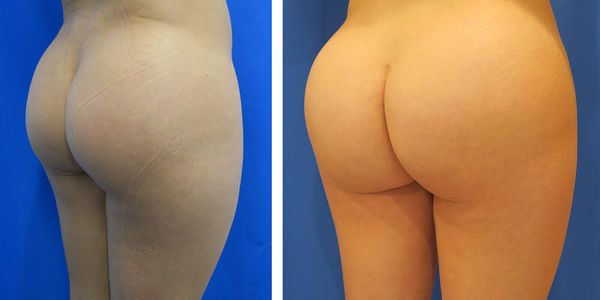 before and after buttock implant right angle view of female patient 766
