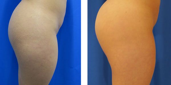 before and after buttock implant right side view of female patient 766