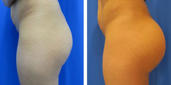 before and after buttock implant left side view of female patient 770