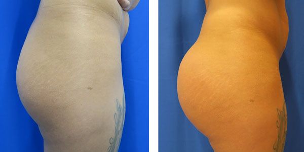 before and after buttock implant right side view of female patient 770