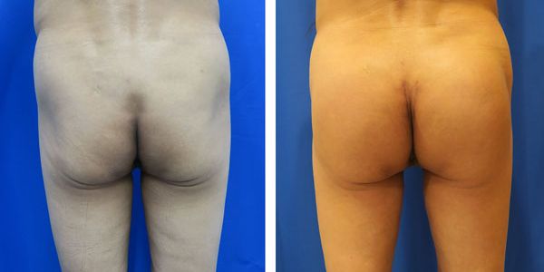 before and after buttock implant rear view of female patient 773