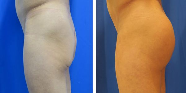 before and after buttock implant left side view of female patient 773