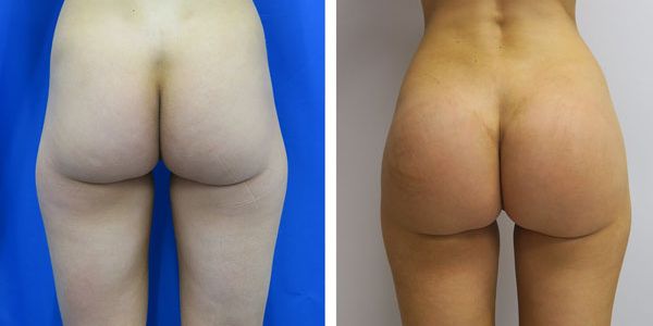 before and after buttock implant rear view of female patient 776