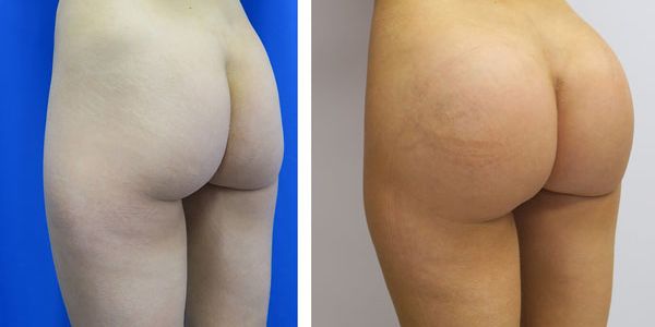 before and after buttock implant left angle view of female patient 776