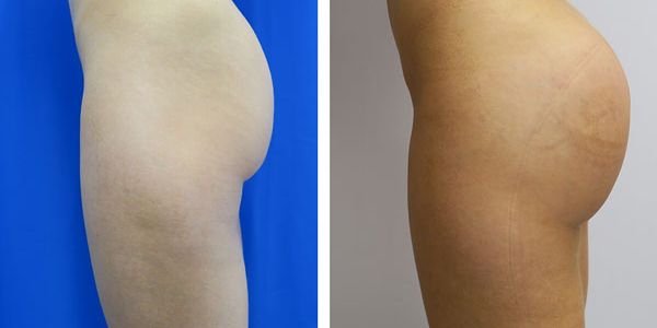 before and after buttock implant left side view of female patient 776