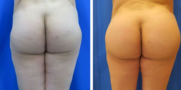 before and after buttock implant rear view of female patient 780