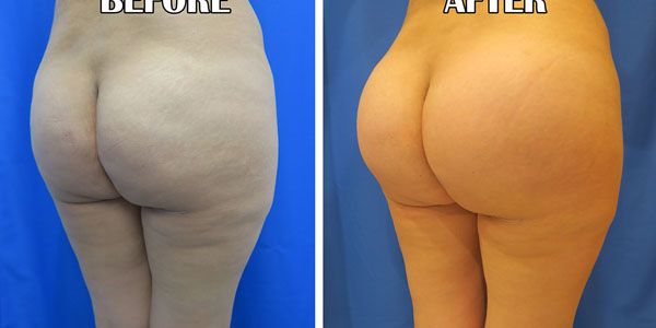 before and after buttock implant right angle view of female patient 786