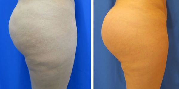 before and after buttock implant right side view of female patient 786