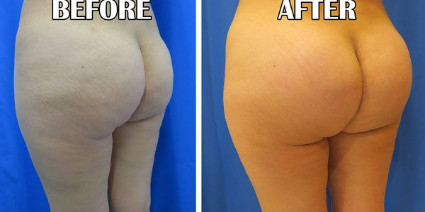 before and after buttock implant left angle view of female patient 786