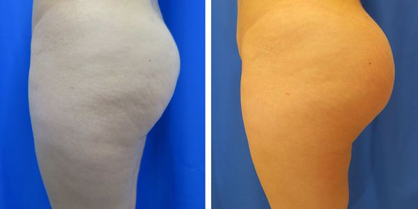 before and after buttock implant left side view of female patient 786