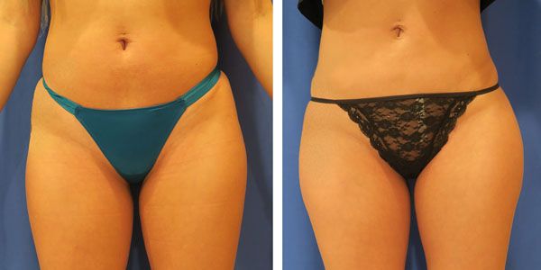 before and after buttock enhancement female patient 795