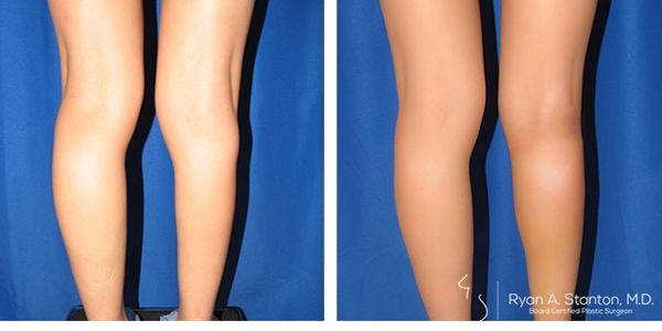 before and after calf implant back view female patient case 803