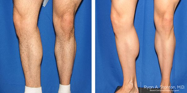 before and after male calf augmentation front and side views