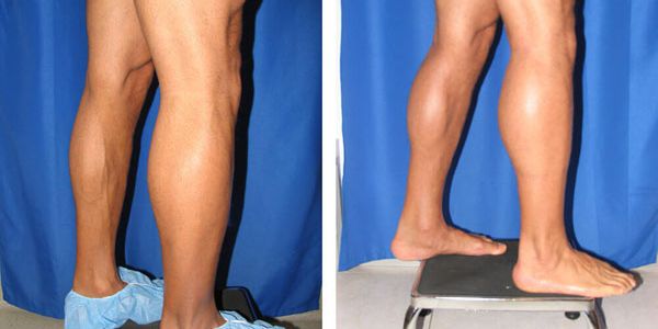 before and after calf implant right side view male patient case 808