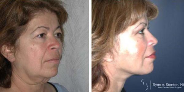 before and after facelift right side view female patient case 829