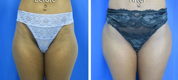 before and after hip implants front view female patient case 851
