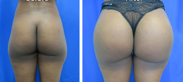before and after hip implants back view female patient case 851