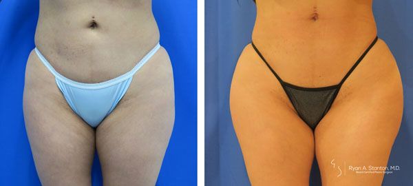 before and after hip implants front view female patient case 856