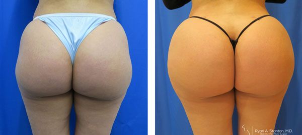 before and after hip implants back view female patient case 856