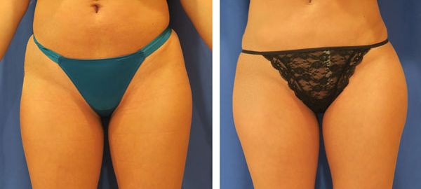 before and after hip implants front view female patient case 859