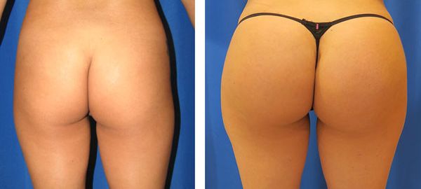 before and after hip implants back view female patient case 861