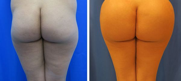 before and after hip implants back view female patient case 863