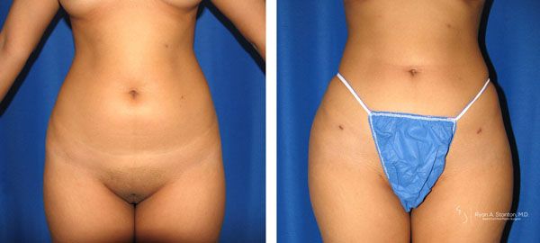 before and after hip implants front view female patient case 865