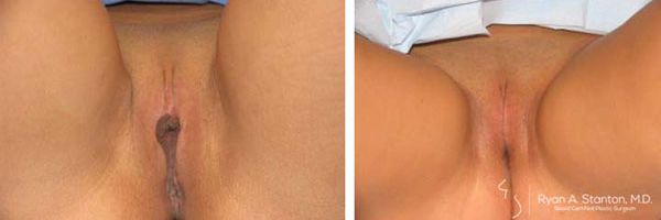 before and after labiaplasty front view female patient case 867