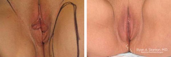 before and after labiaplasty front view female patient case 869