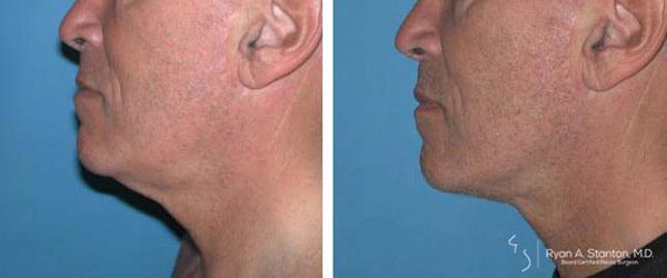 before and after neck lift left side view male patient case 918