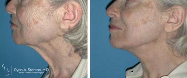 before and after neck lift left side view female patient case 932