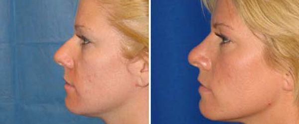 before and after rhinoplasty left side view female patient case 968