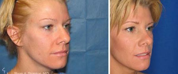 before and after rhinoplasty right angle view female patient case 968