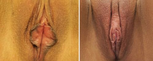 before and after vaginal rejuvenation front view female patient case 1000