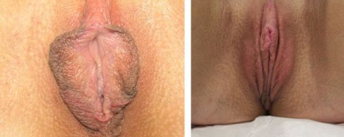 vaginal rejuvenation before after case 4