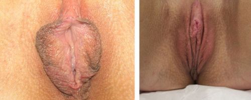 before and after vaginal rejuvenation front view female patient case 996