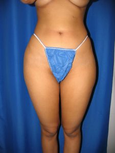 after hip implants case 1