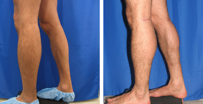 before and after male calf implants right side view male patient case 101