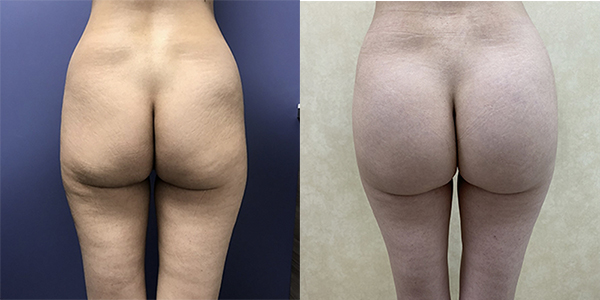 Before and after butt implant back view female patient case 1243