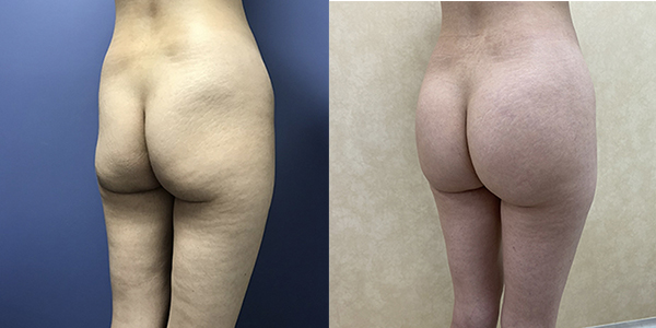 Before and after butt implant left angle view female patient case 1243