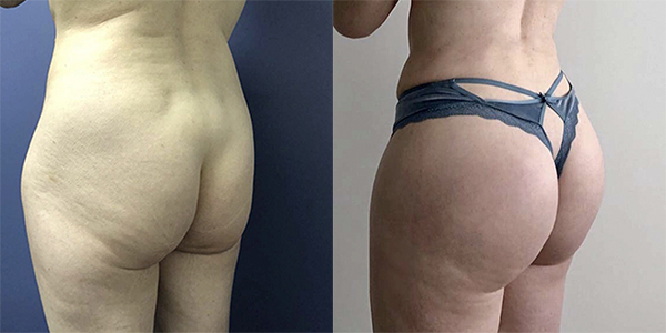 Before and after butt implant left angle view female patient case 1268