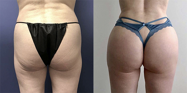 Before and after butt implant back view female patient case 1268