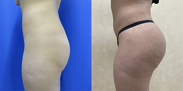 Before and after hip implants left side view female patient case 1249