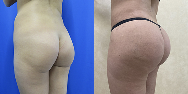 Before and after hip implants right angle view female patient case 1249