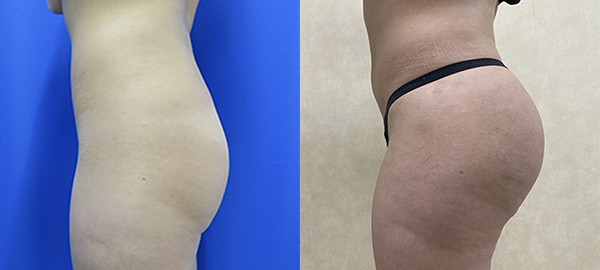 Before and after hip implants left side view female patient case 1256