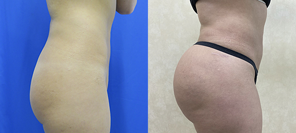 Before and after hip implants right side view female patient case 1256