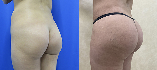 Before and after hip implants left angle view female patient case 1256