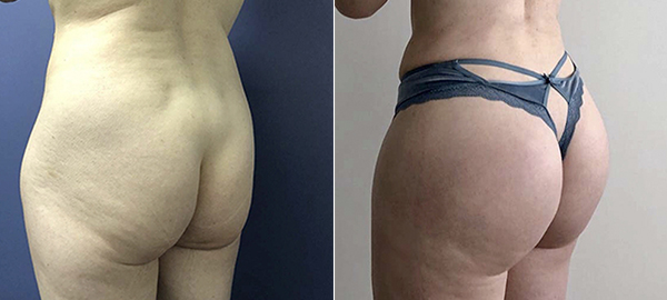 Before and after hip implants left angle view female patient case 1280