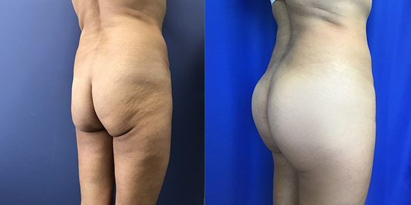 Before and after butt implants case right angle view female patient 1295