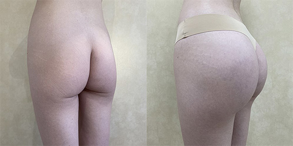 Before and after butt implants case left angle view female patient 1360